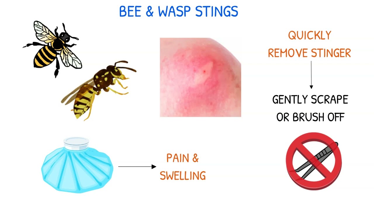 РУКОВОДСТВО ДЛЯ СТУДЕНТОВ-МЕДСЕСТЕР: Укусы скорпионов, пчел/ос и змей