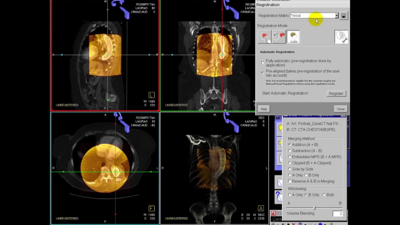 3D Planning and Robotic-Guided Fenestration (Alan B. Lumsden, MD)