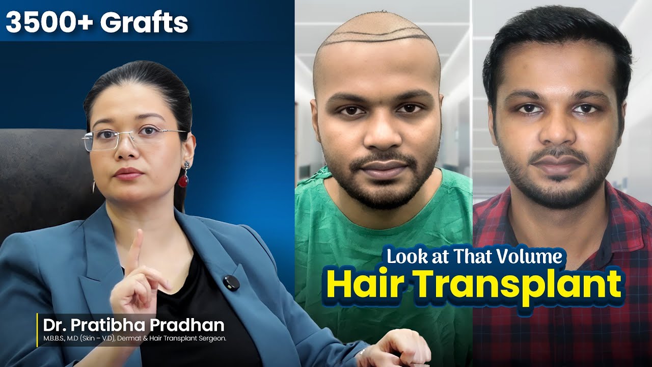 Case Study: 3510 Grafts Hair Transplant | 10-Month Transformation #hairtransformation