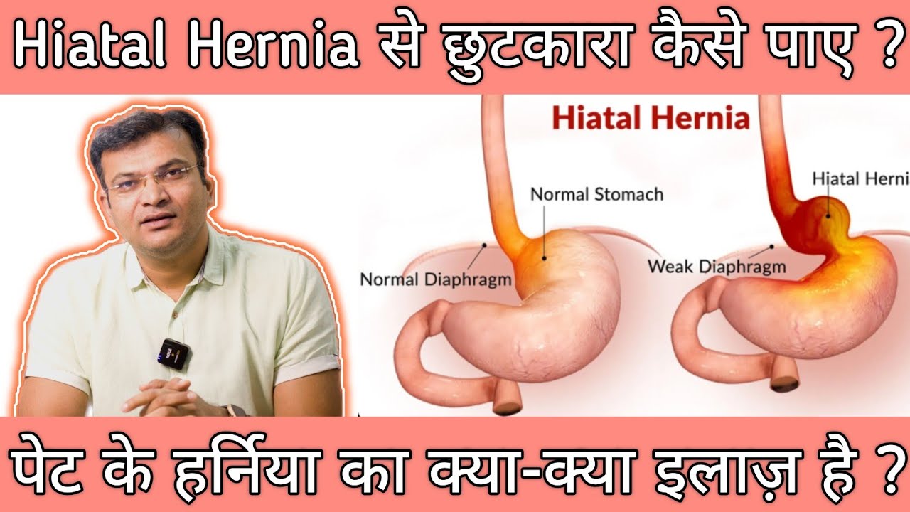 पेट का हर्निया (हाइटस हर्निया) का इलाज़ | Hiatus Hernia Treatment | Dr Arvind Namdeo