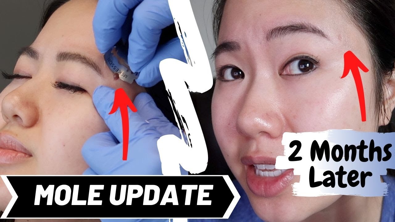 Facial Mole Removal Healing Process + 2 Month Update // Regrets? | Mole Shaving Experience