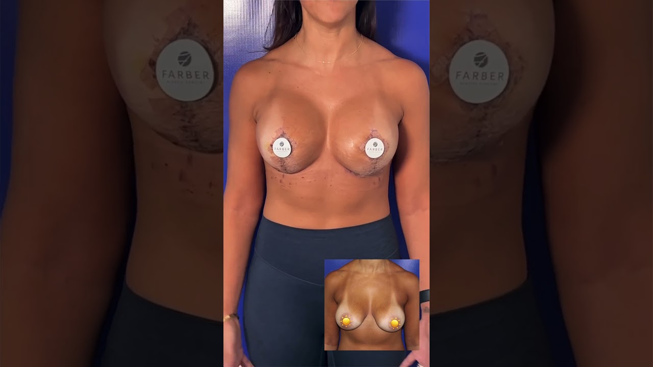 Review Revision Breast Surgery With Dr. Farber - 2 Weeks Post-Op