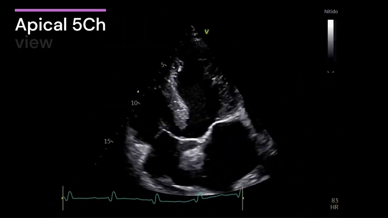Aortic Root Aneurysm and Severe Aortic Regurgitation