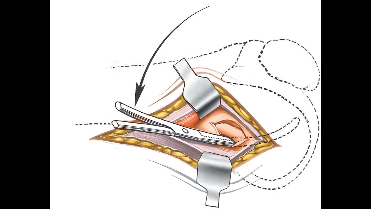 The lateral approach to the distal femur, known as the “over-the-top” approach.