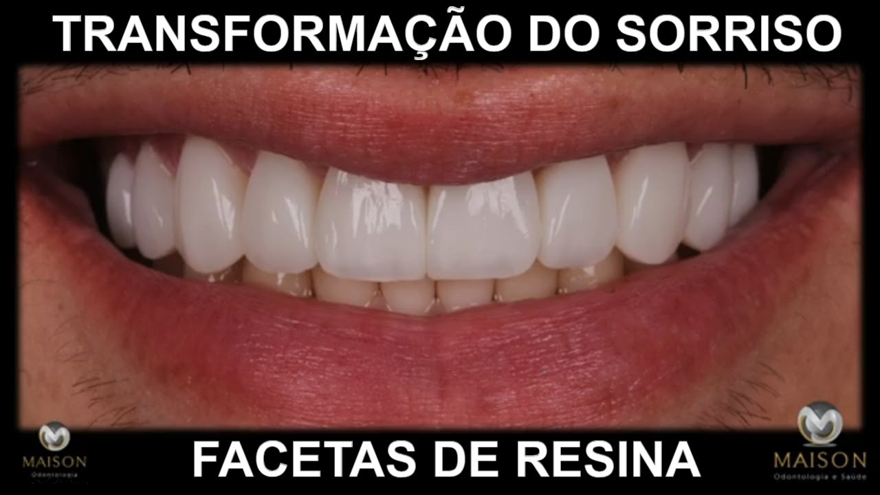 Quer transformar seu sorriso e aumentar sua autoestima? - FACETAS DE RESINA
