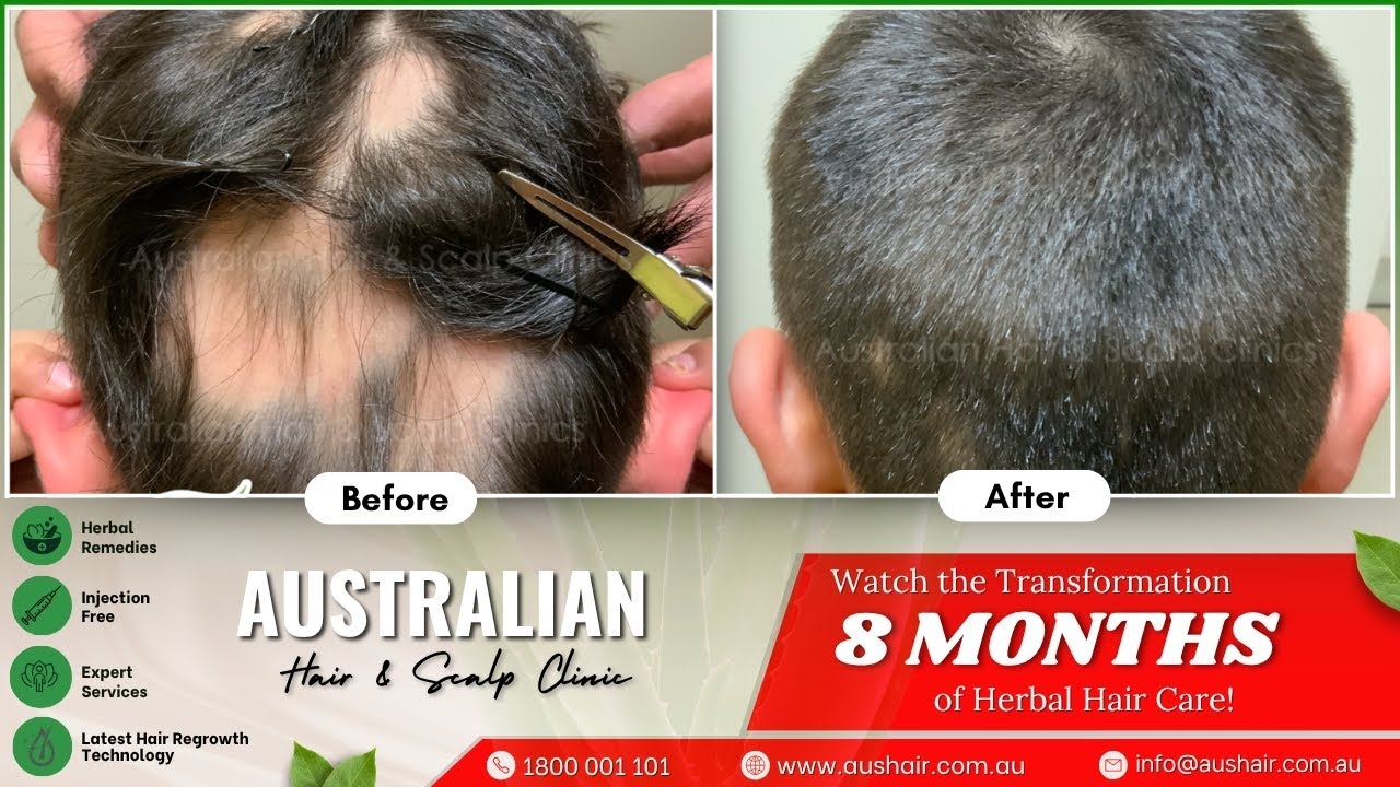 Alopecia Areata in Kids: A Journey to Hair Regrowth Success! | Safe & Effective Treatment