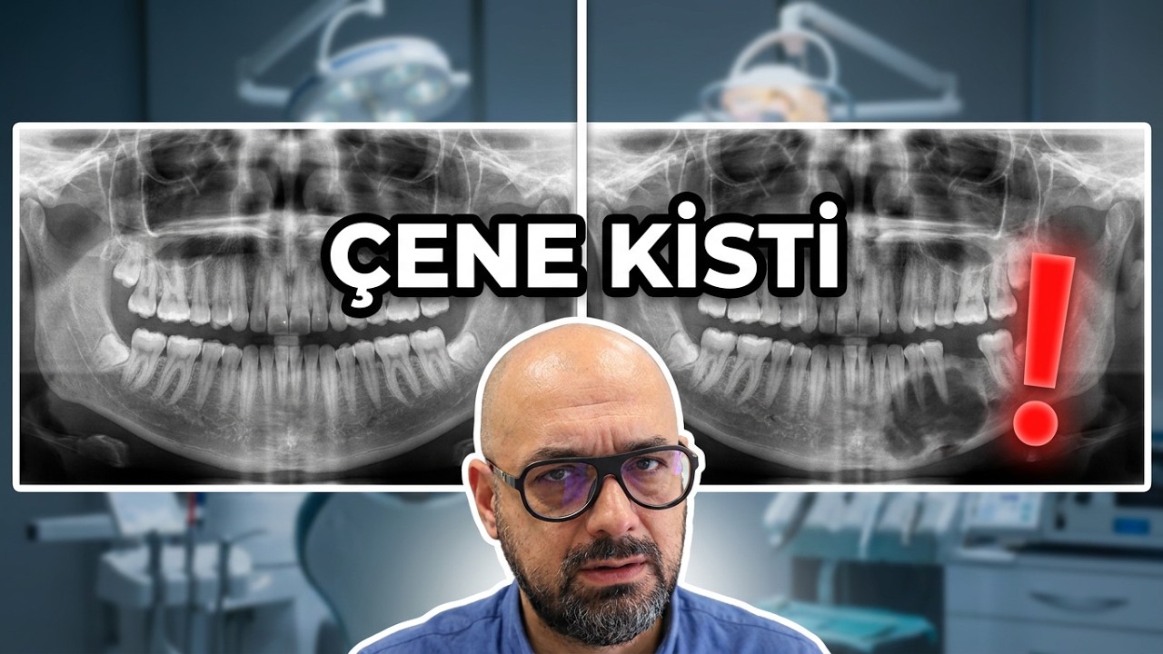 Diş Kaynaklı Çene Kistleri Nasıl Tedavi Edilir?