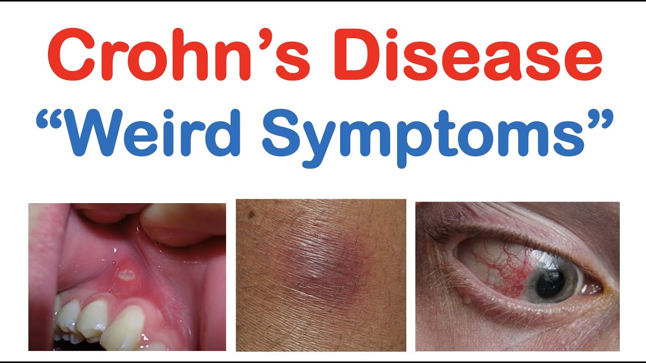 Stranger Than You Think… | Crohn’s Disease Weird Symptoms