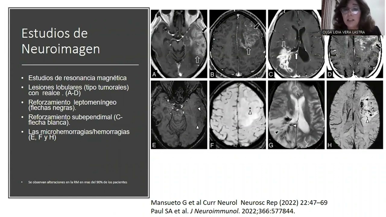 4. Vasculitis Primaria del Sistema Nervioso Central. Dra. Olga Lidia Vera Lastra