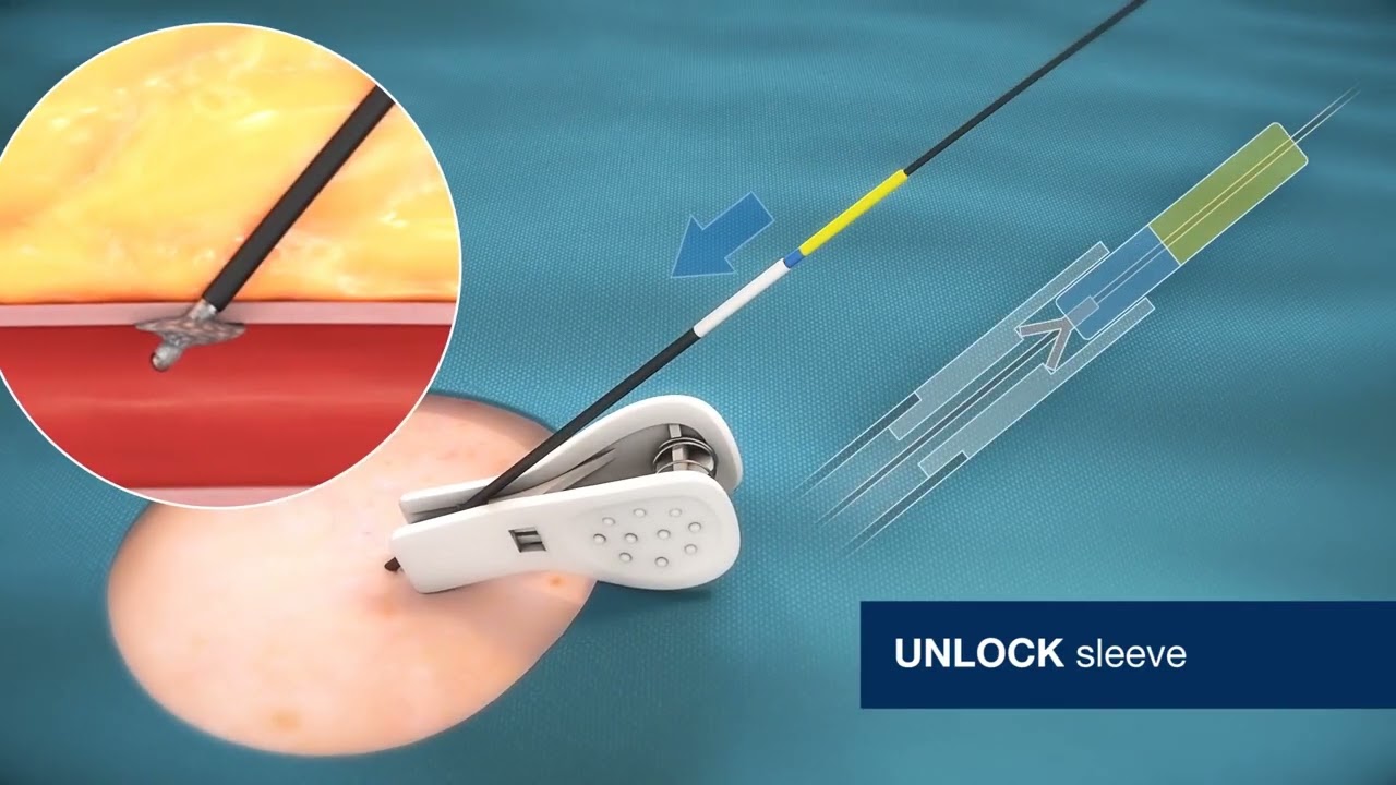 VASCADE Deployment Animation LIT 3870 - Rev B