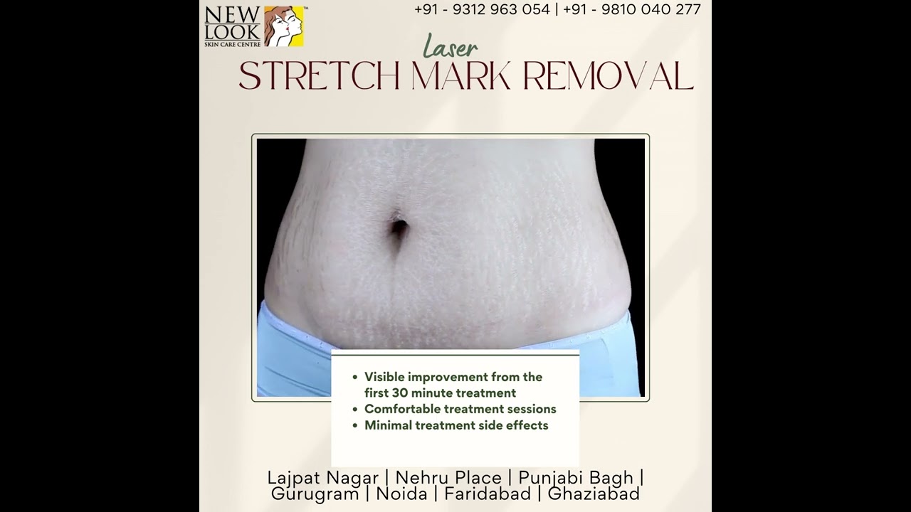 Laser Stretch Mark Removal Treatment