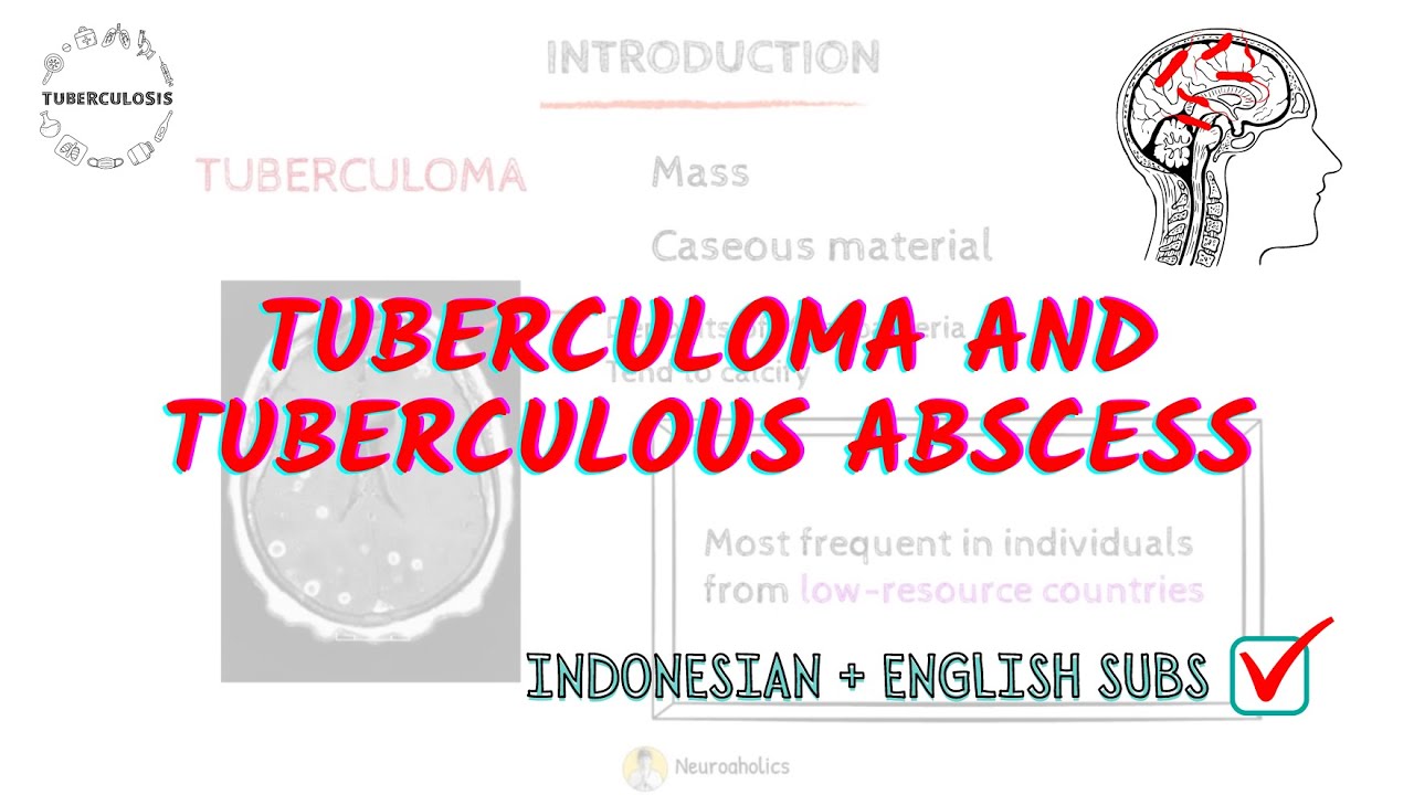 Tuberculoma vs Tuberculous Abscess: Symptoms, Diagnosis, and Treatment