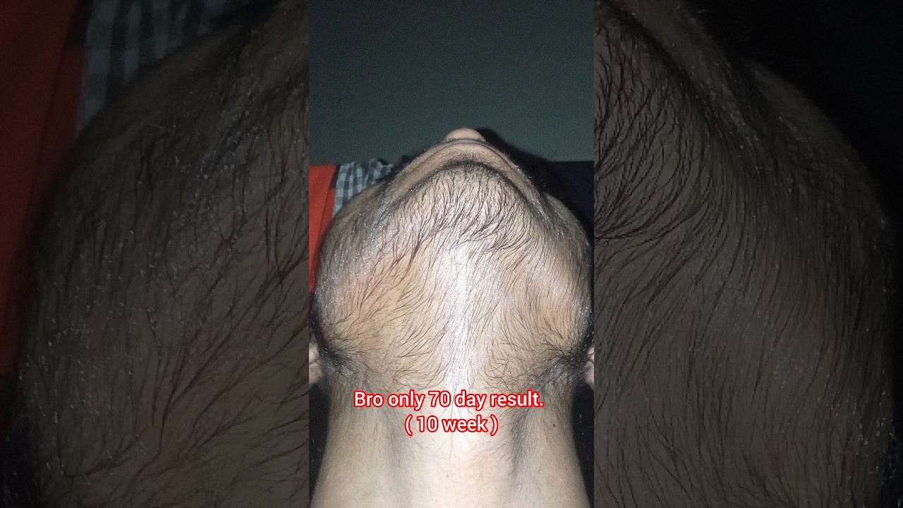 Natural beard growth journey man matters minoxidil beardmax 5% #viralshorts