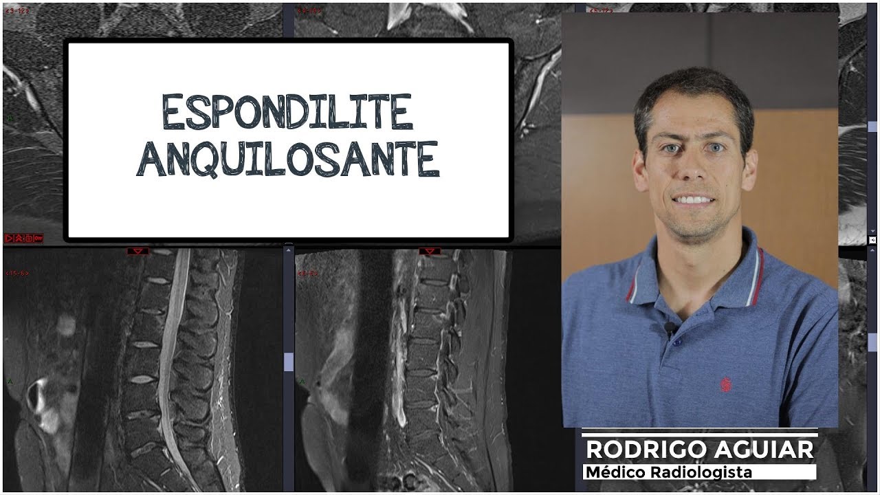 Espondilite Anquilosante