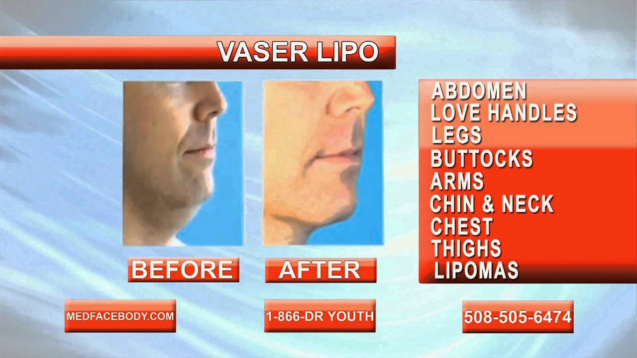 VASER Lipo Video by Dr. Dave David