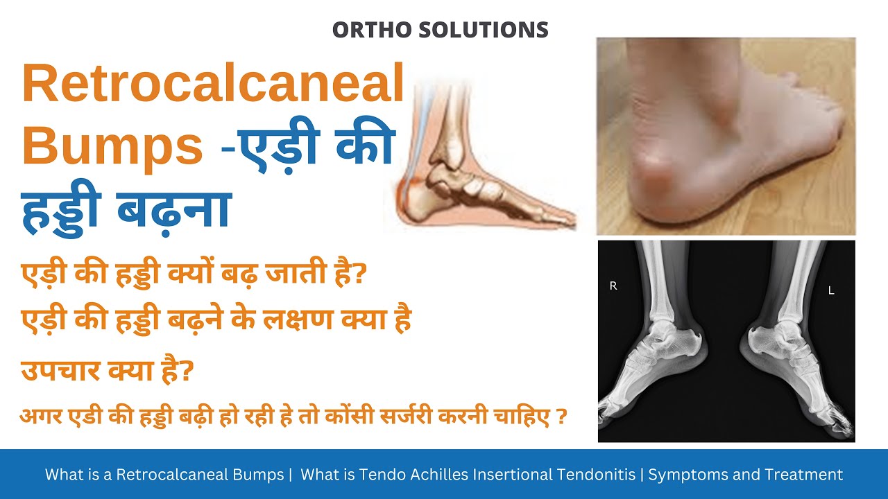 एड़ी की हड्डी बढ़ रही है तो उपचार क्या है  | Heel Bone Pain Treatment Hindi | एड़ी के दर्द का उपचार