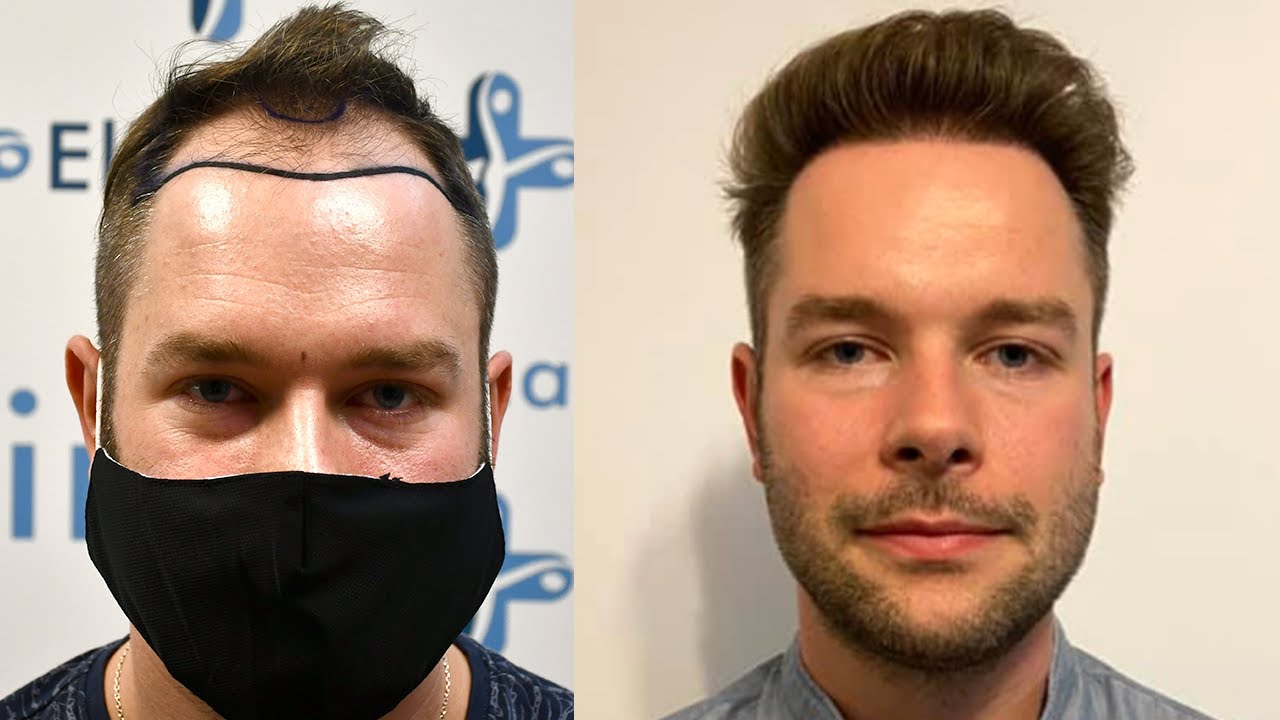 Greffe de cheveux de Michael avant/après : Résultats mois par mois #5 | Elithair