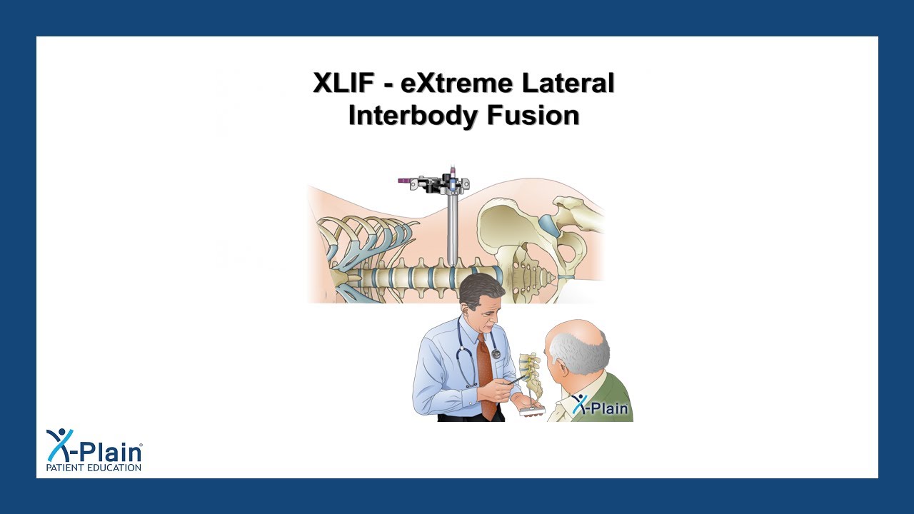 XLIF - eXtreme Lateral Interbody Fusion