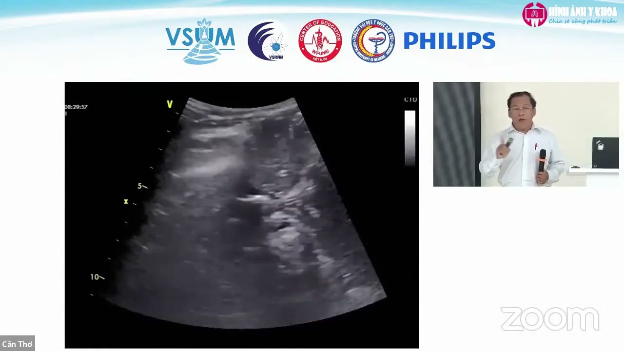 [CME 2022] 06 Siêu âm chẩn đoán hội chứng nôn ói ở trẻ em - BS.CK2. Nguyễn Hữu Chí