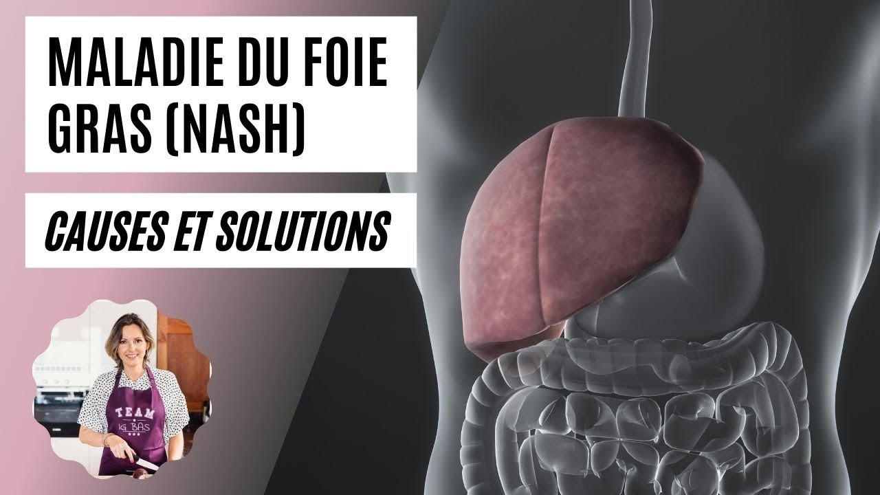 NASH : stéatose hépatique (foie gras) / causes et solutions