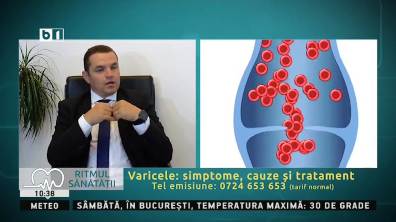 RITMUL SĂNĂTĂȚII- VARICELE: SIMPTOME, CAUZE, TRATAMENT