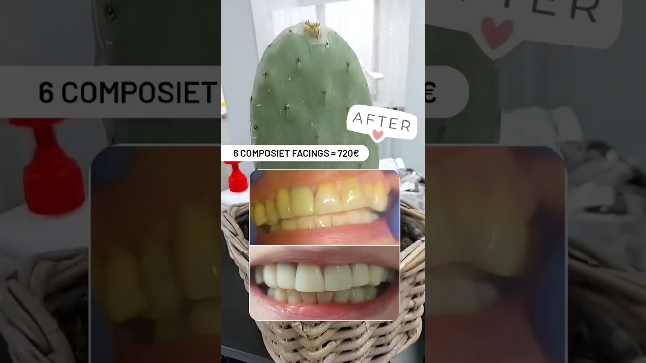 Composiet facings de oplossing voor een mooi gebit