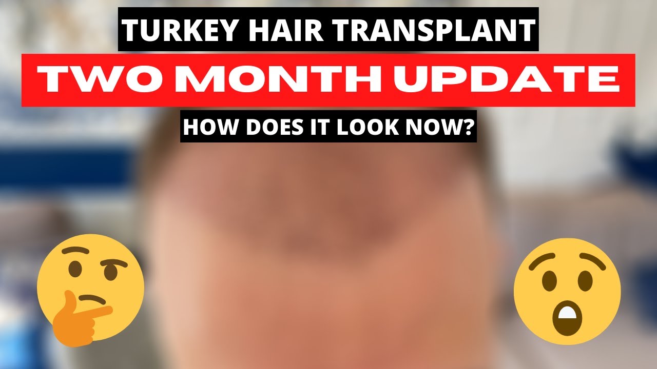 Обновление за два месяца - пересадка волос методом FUE в Турции, салон Hair of Istanbul.
