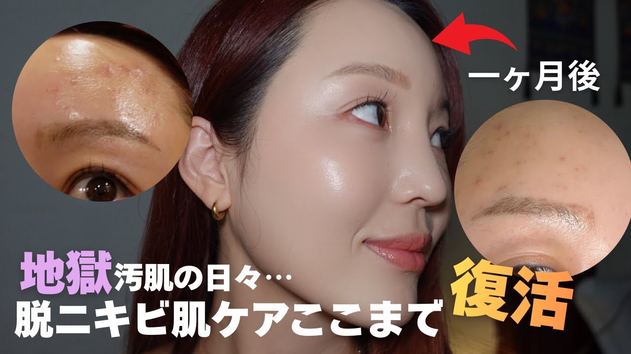 【ニキビ肌】ニキビの種類別に改善策を解説！本気で肌に向き合いました。このスキンケアは試す価値あり💭