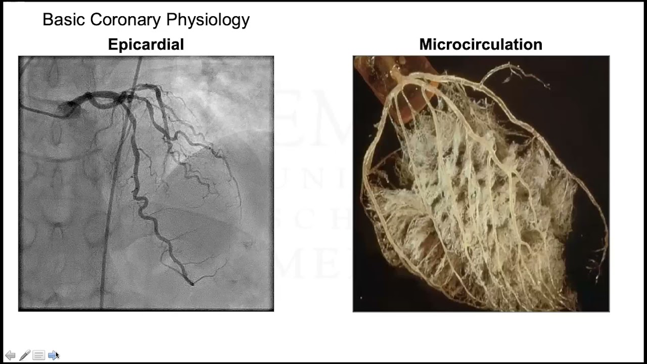 Coronary Microvascular Dysfunction in Contemporary Practice: Demystifying Angina w/ Open Coronaries