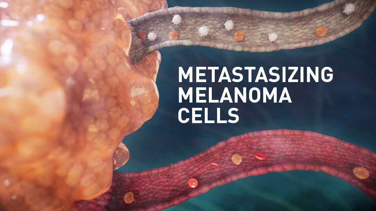 Lymph protects metastasizing melanoma cells from ferroptosis | MoD Animation