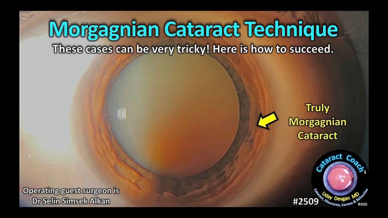 CataractCoach&trade; 2509: Morgagnian cataract surgery technique