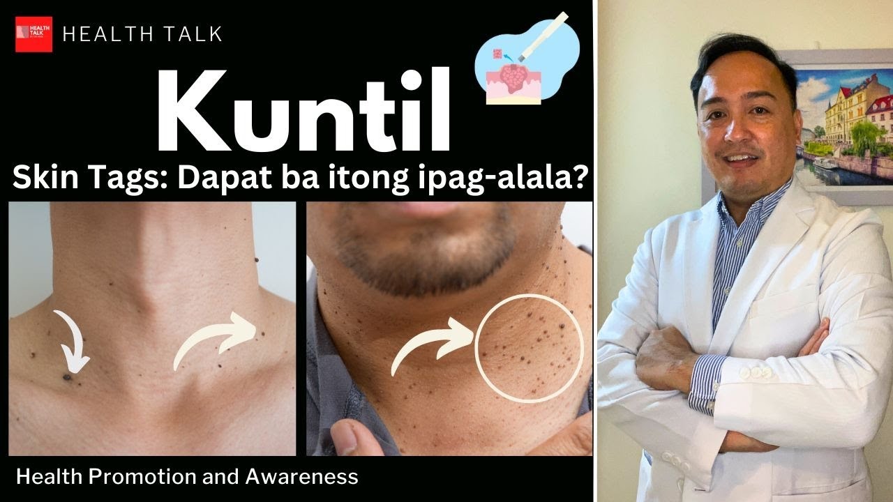 Kuntil: Skin tags dapat ba itong ipagalala?