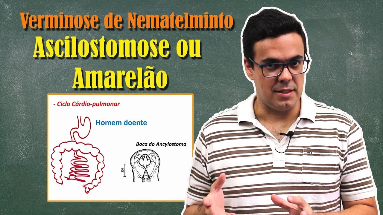 Ancilostomose, Amarel&atilde;o ou Doen&ccedil;a do Jeca Tatu
