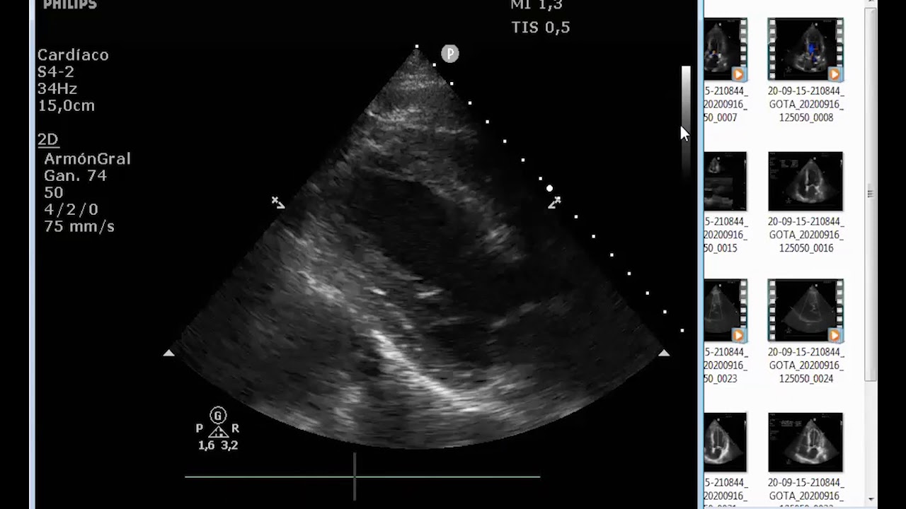 Ateneo IMedCV - Stent trombosis vs Reestenosis de stent - Dr Antunez Ramiro