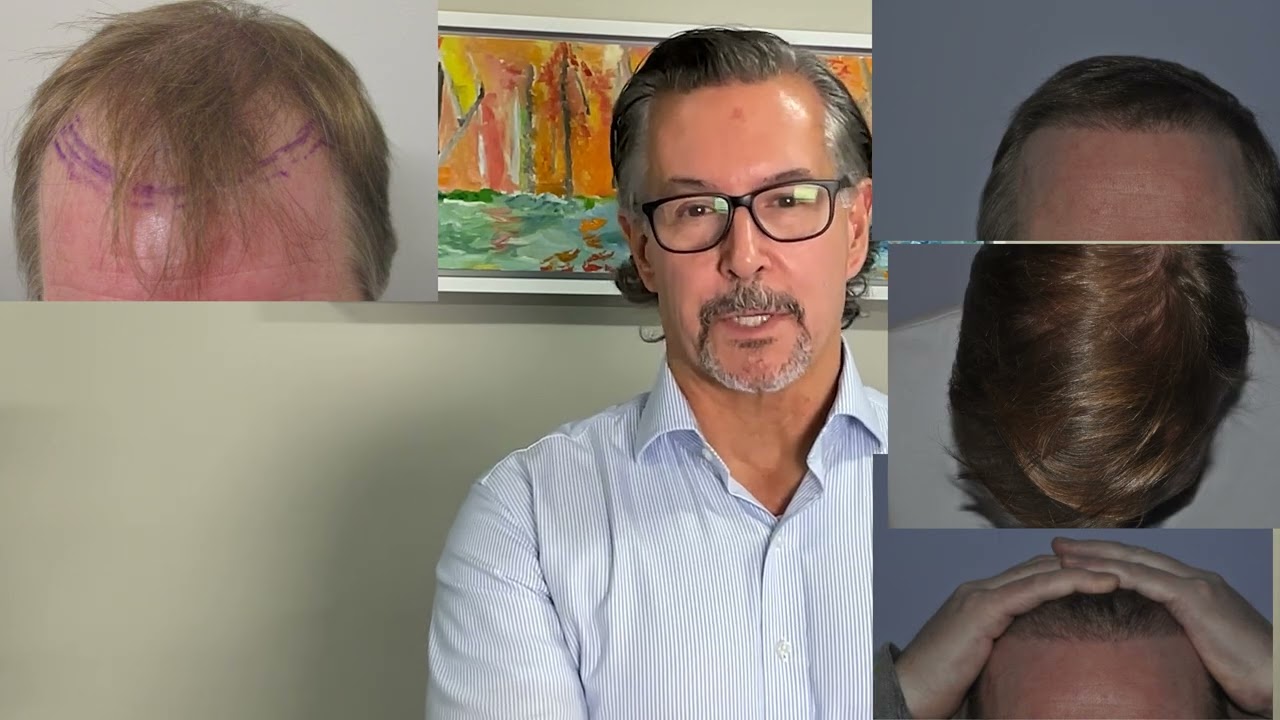 Excellent fine hair transplant result in 50 year old 2 years after hair restoration with Dr. Lindsey