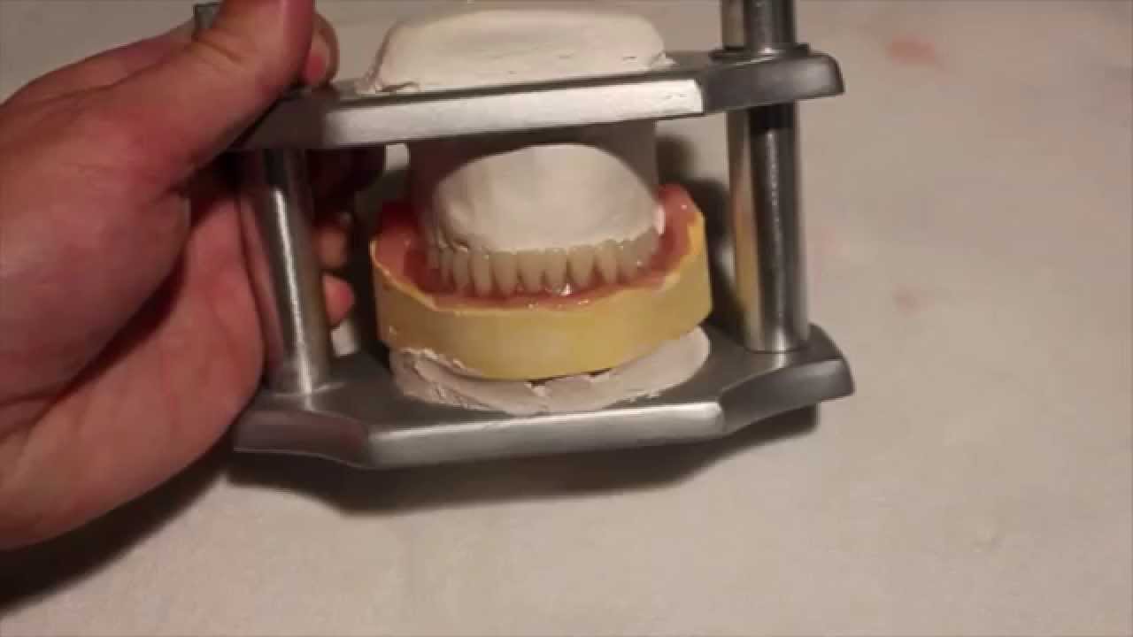 A complete silicone reline using Dentusil