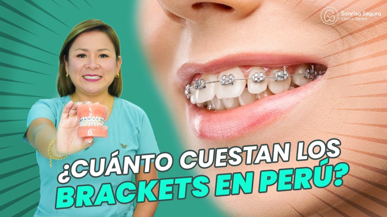 Brackets en Perú: ¿Cuánto Cuestan Realmente y Qué Debes Saber?