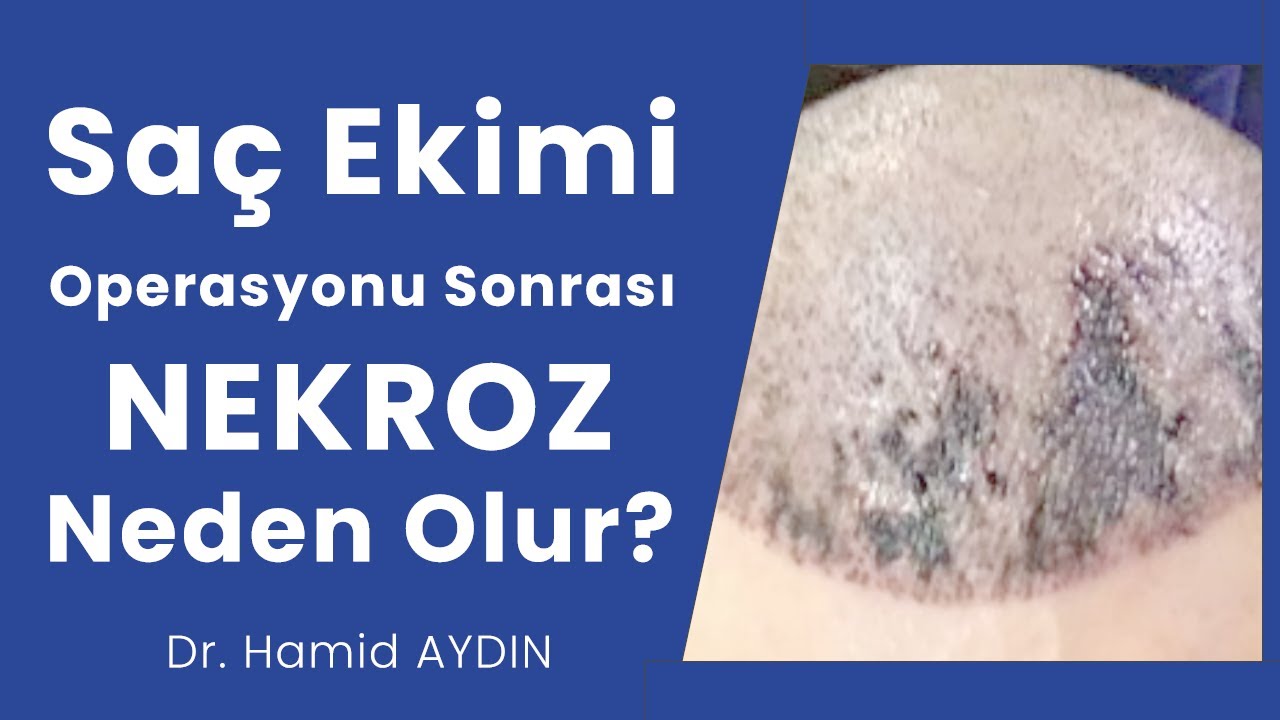 Saç Ekimi Operasyonu Sonrası Nekroz Neden ve Nasıl Olur?