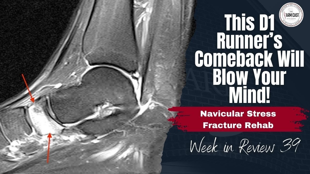 This D1 Runner&rsquo;s Comeback Will Blow Your Mind: Navicular Stress Fracture Rehab: Week in Review 39