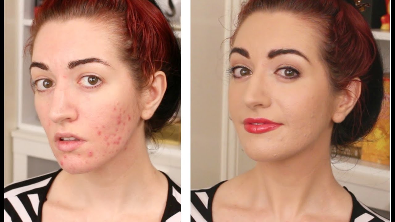 How To Cover Acne & Scarring • My Full Coverage Foundation Routine