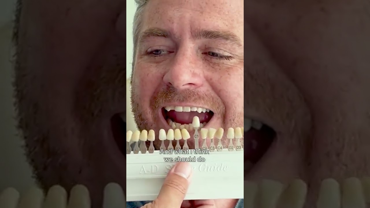 Choosing the right color for his new smile makeover 🦷. It really suits Jed. #shorts #teeth