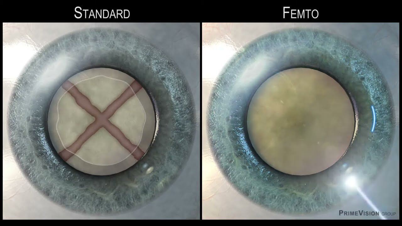 Intervento di Cataratta - Standard vs Femto