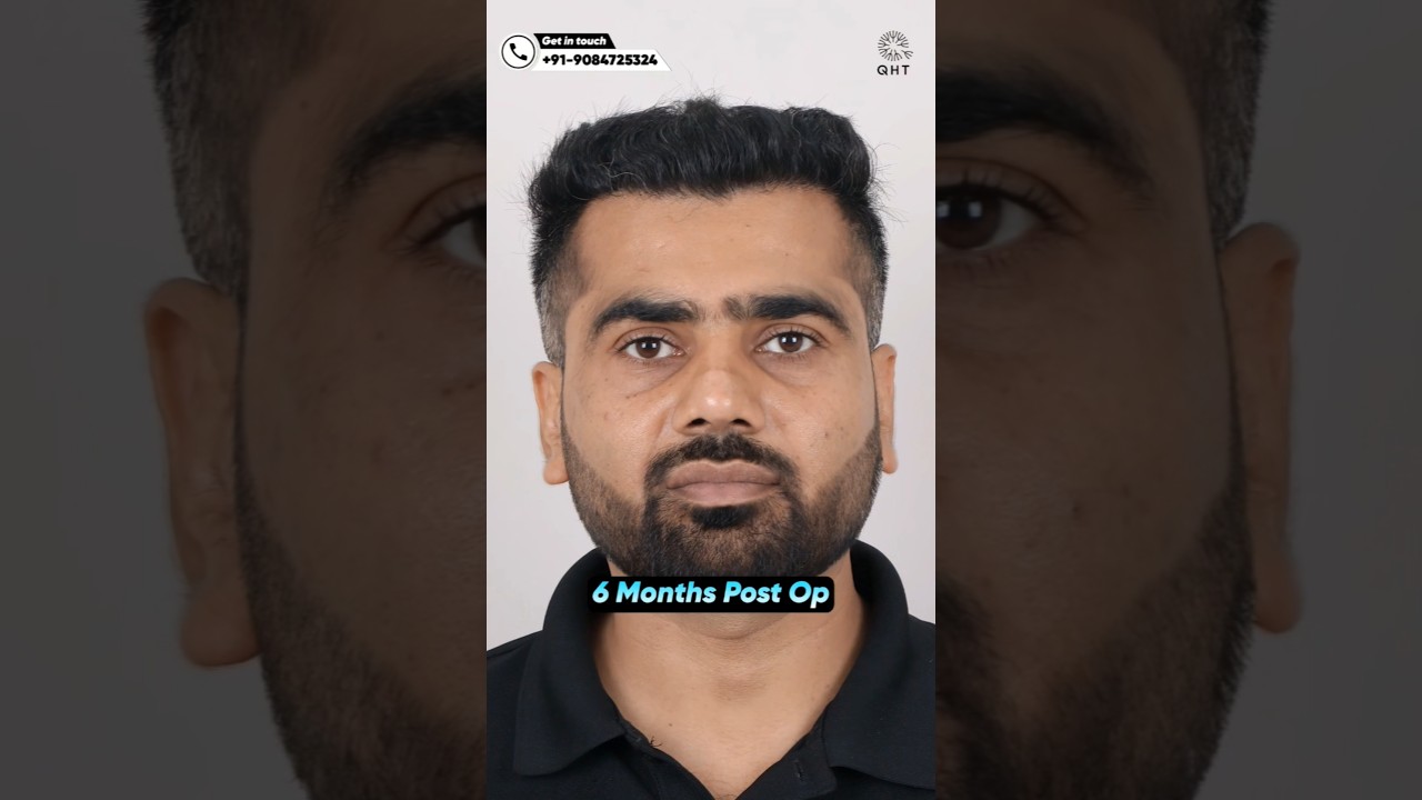 Hair Transplant 6 Months Result #qht #hairtransplant #ytshortsindia #shorts #trending #hairloss #fue