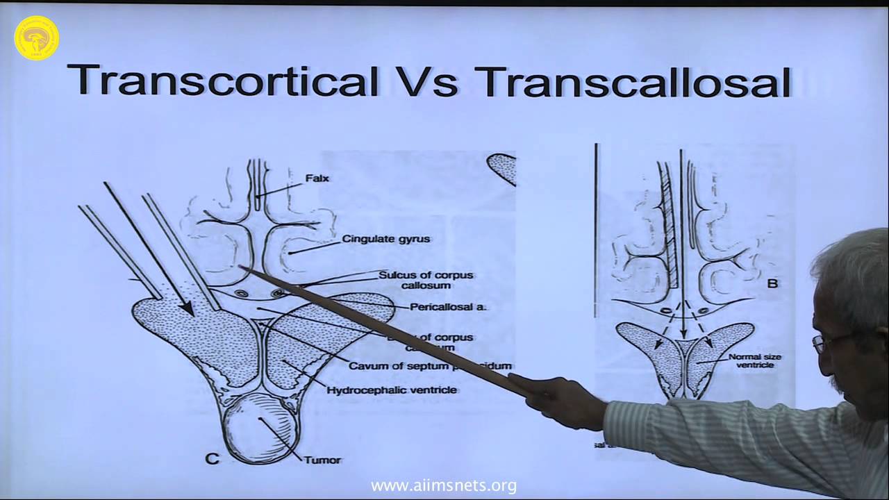 Ventricles of the Brain  Surgical Anatomy and its Approaches