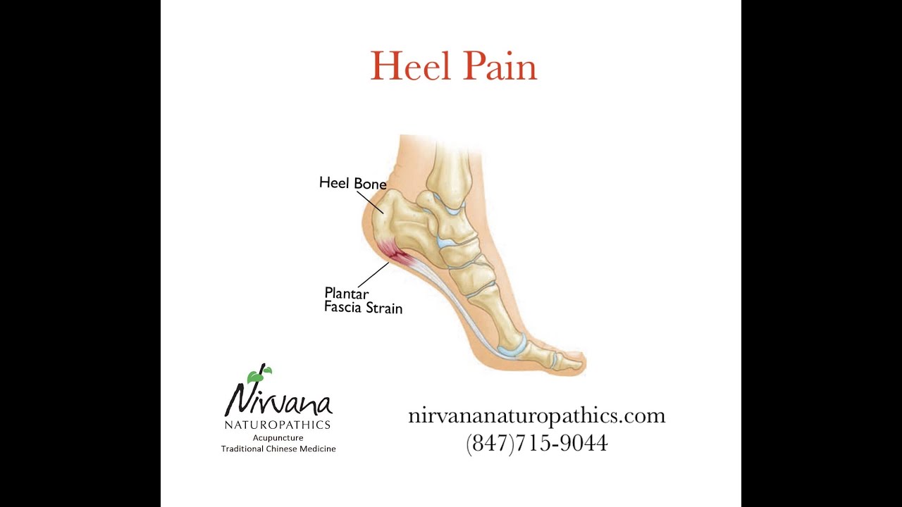 TREATING PLANTAR FASCIITIS AND HEEL PAIN WITH ACUPUNCTURE
