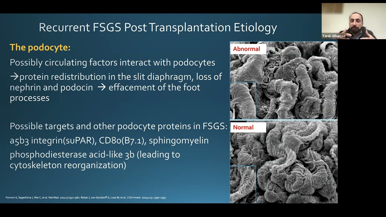 Treating recurrent FSGS in post kidney transplant patients - CME Recording