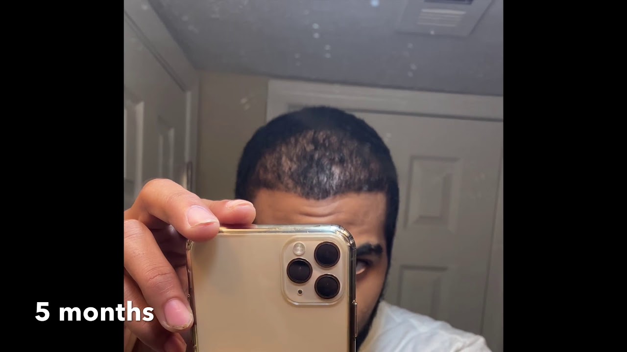 5 & 6 Month Post Op - African American Hair Transplant FUE