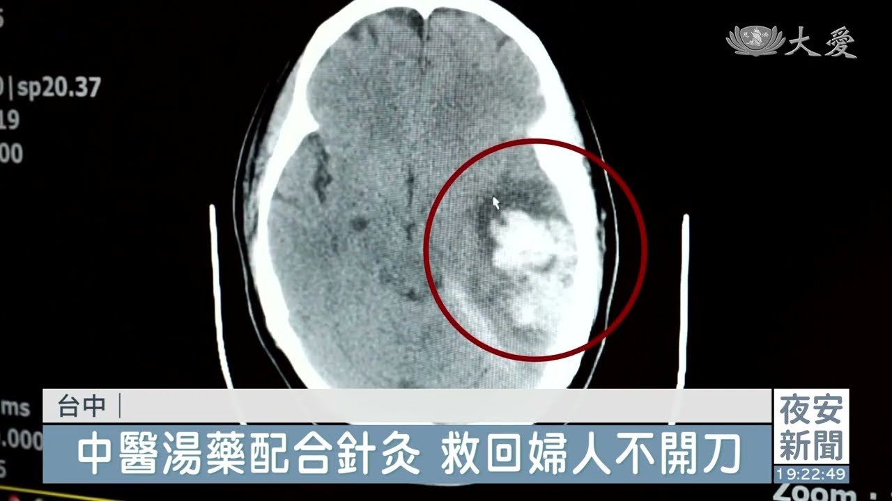 跌倒腦出血昏迷 中醫加入救回婦人