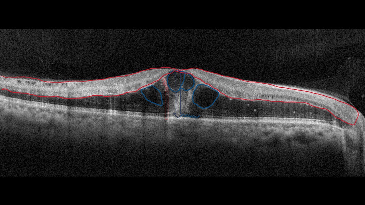 Course in clinical applications of OCT for macular diseases - Non-Diabetic retinal vascular diseases