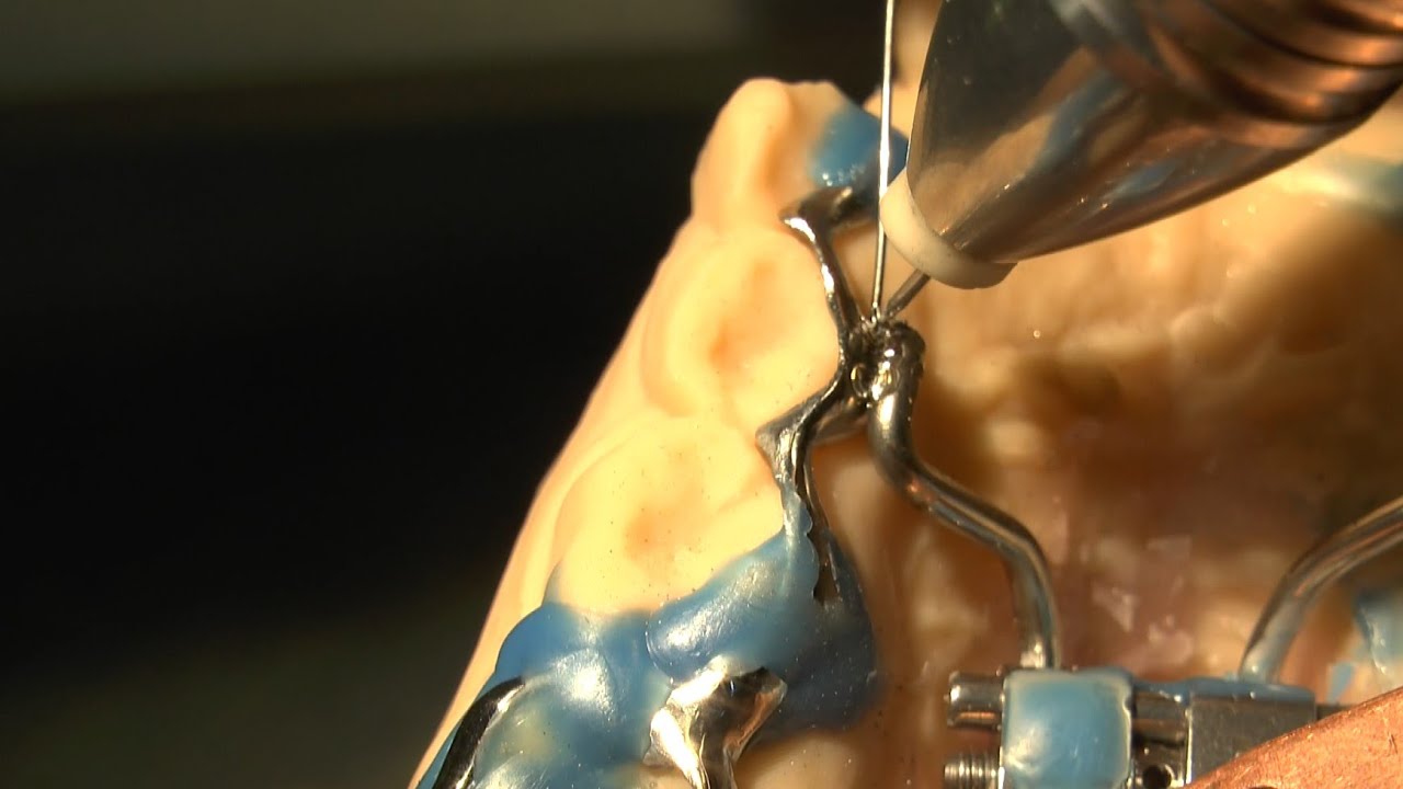 PUK dental welding - palatal expansion II Gaumennahterweiterung